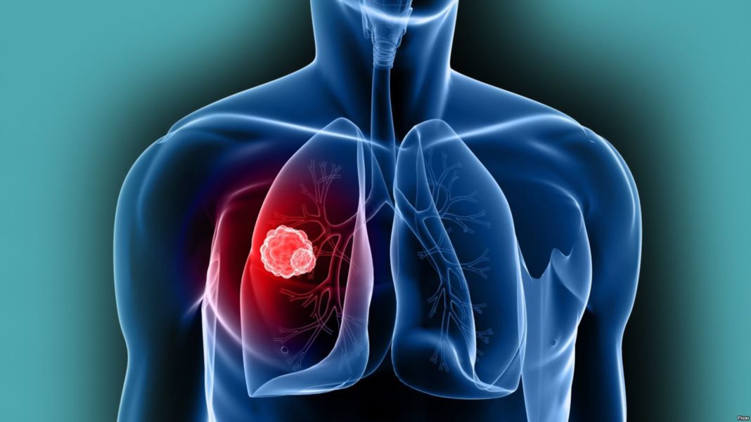 Факторы, повышающие риск развития рака лёгкого у мужчин
