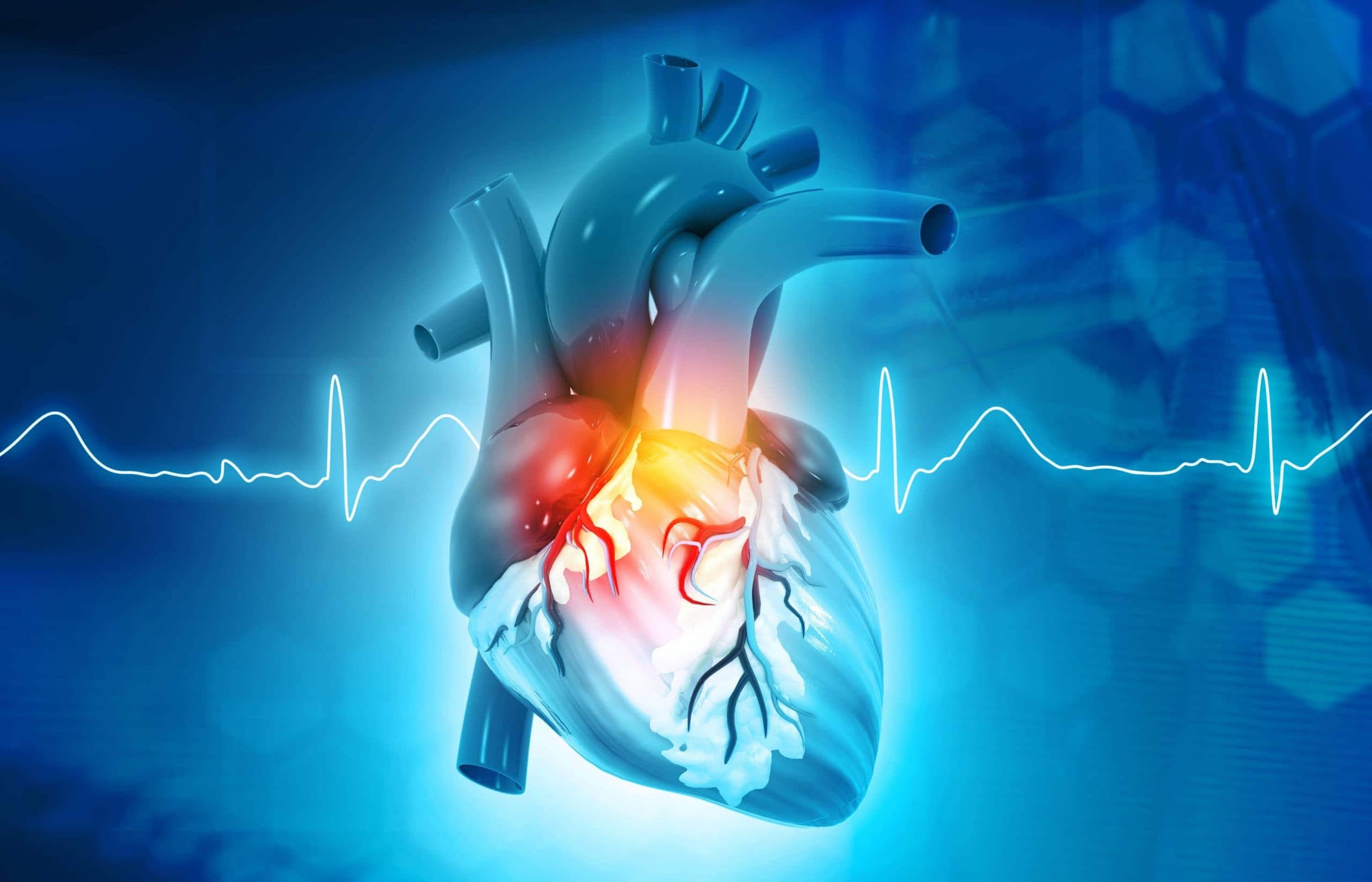 Эффективно снизить риск развития осложнений при фибрилляции предсердий позволяет ранний контроль сердечного ритма